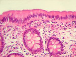 F,52y. | spirochetosis … colon (HE) … blue-stained brush border